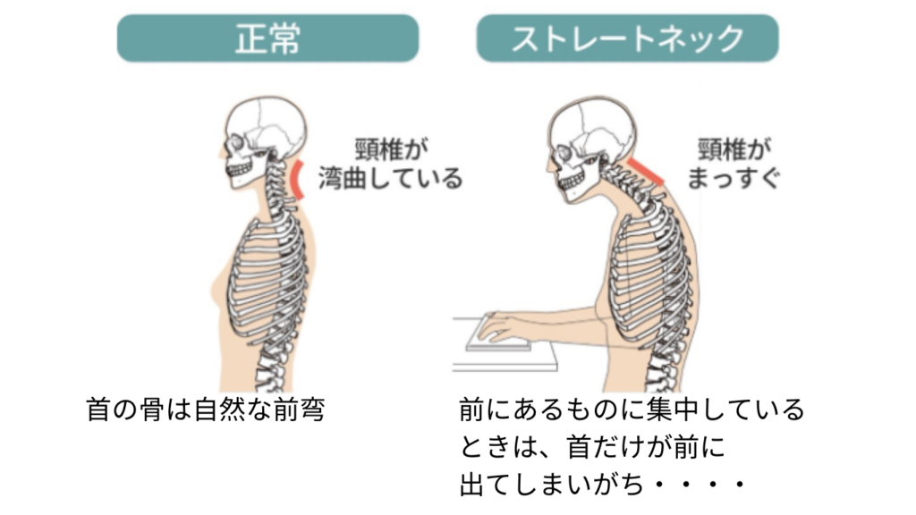 スマホ首の頸椎の状態と正常な頸椎の違い