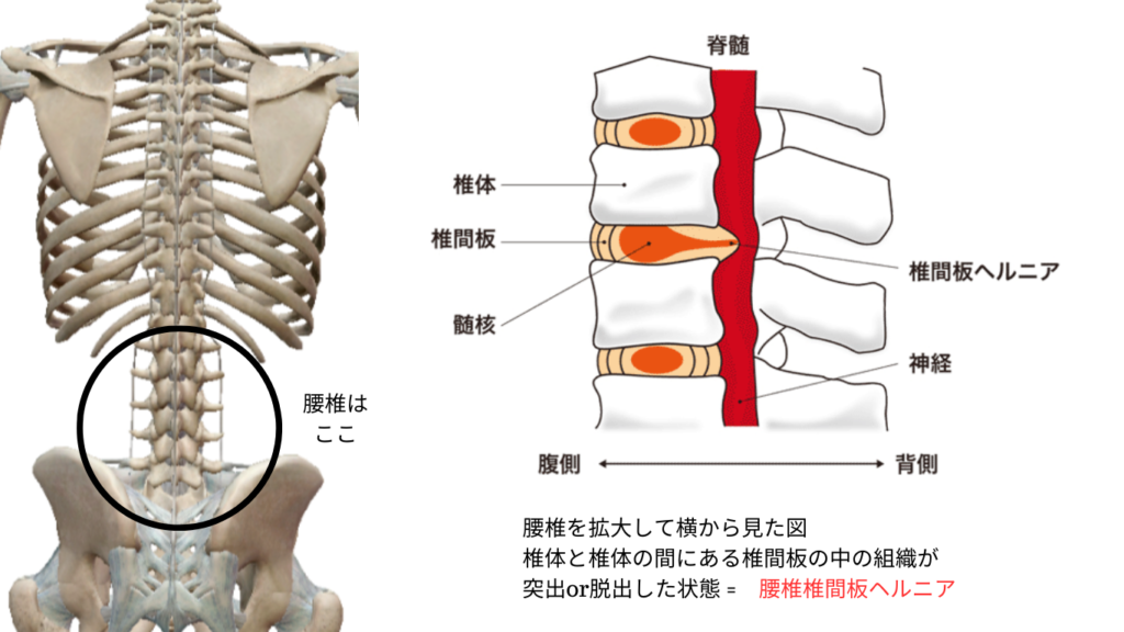 腰椎と椎間板ヘルニアの図（パーソナルピラティス＆ヨガsmile）