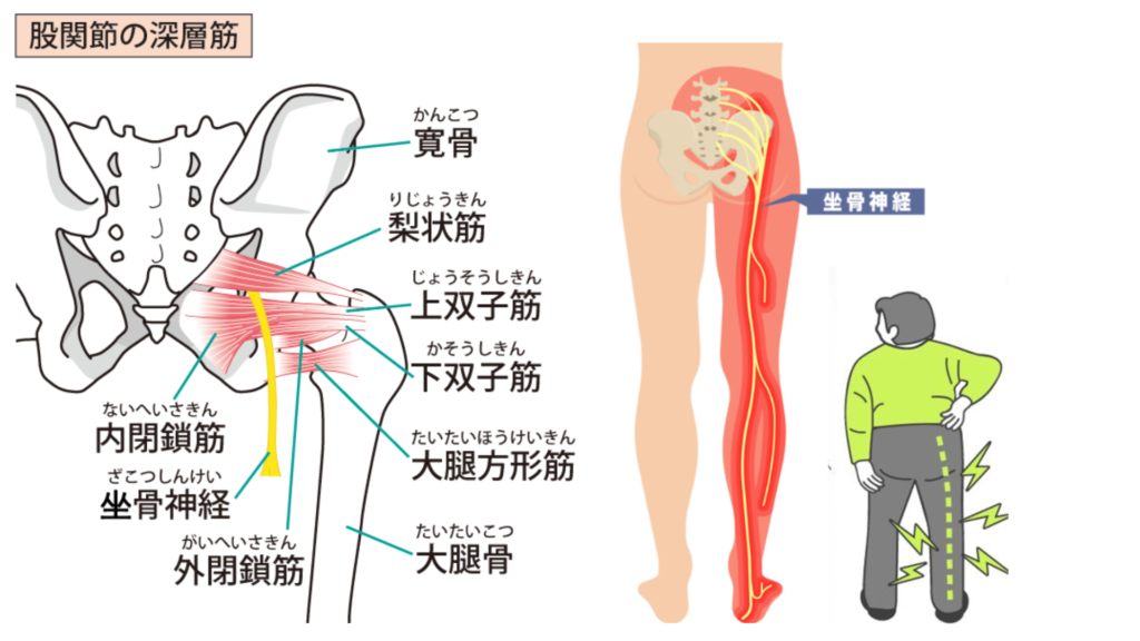 坐骨神経の場所と痛みのイメージ