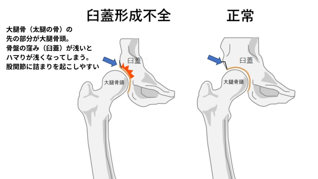 股関節臼蓋形成不全