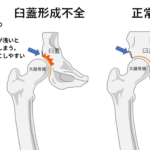 股関節臼蓋形成不全