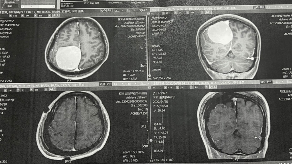 髄膜種のMRI写真：手術できれいに摘出できました（パーソナルピラティス＆ヨガsmile）